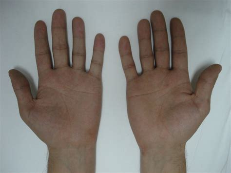 A neurological examination showed hypothenar atrophy on the left hand ...