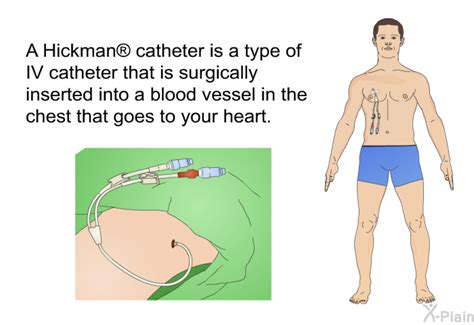 PatEdu.com : Hickman Catheter Care at Home