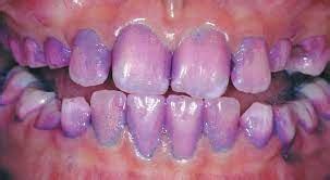 Purple Gums: What Is Purple Gums How To Get It?