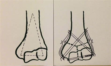 Application of modified tension band wiring technique (Left side:... | Download Scientific Diagram