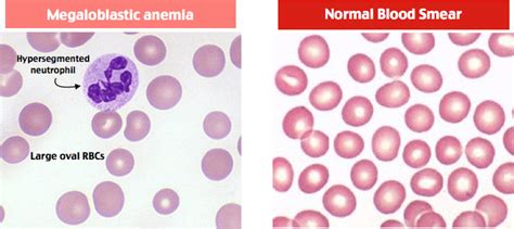 Rapid Review: Megaloblastic Anemia - RoshReview.com