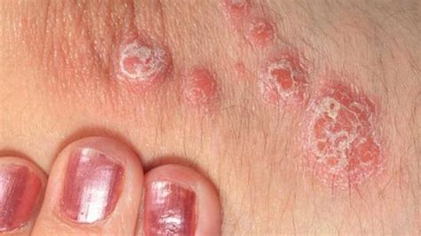 Apa Itu Penyakit Kulit Psoriasis - MHomecare Blog