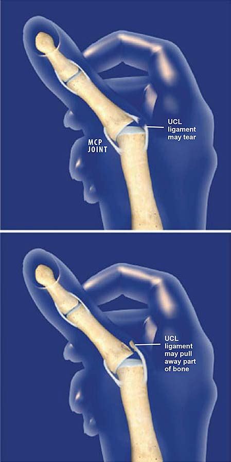 Thumb Ulnar Collateral Ligament (UCL) Injury | Central Coast Orthopedic Medical Group