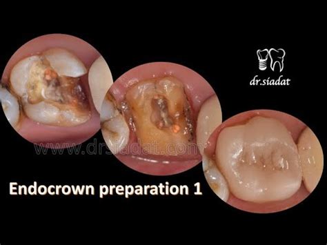 endocrown preparation 1 - YouTube