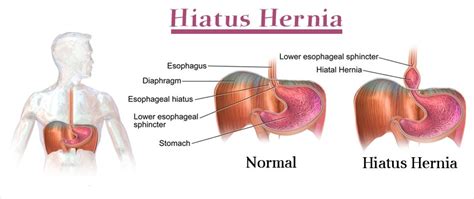 Esophageal hiatus – Anatomy, Location, Function, Hernia and Pictures ...