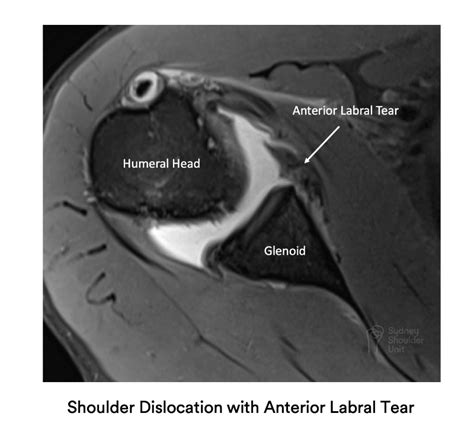 Mri Shoulder Labrum Tear