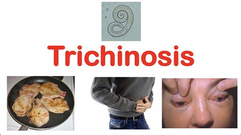 Trichinosis (Pork Parasite) | Pathophysiology, Signs & Symptoms, Diagnosis, Treatment - YouTube