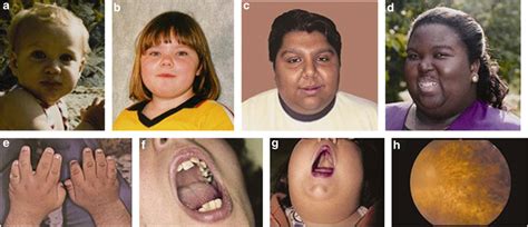 Images of patients demonstrating the dysmorphic features associated...