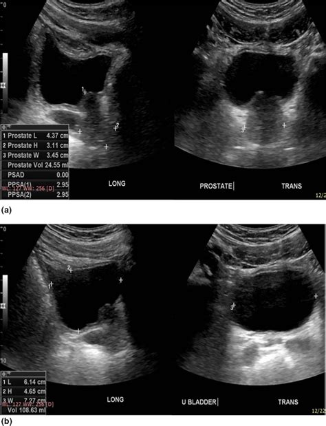 Enlarged Prostate Ultrasound