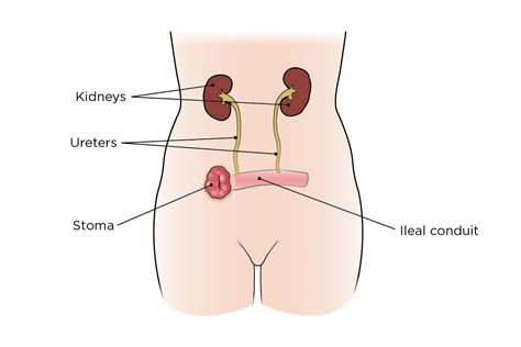 Bladder Cancer Surgery | Memorial Sloan Kettering Cancer Center