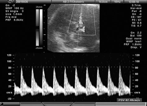 Fetal anaemia: two clinical cases with fetal blood transfusion