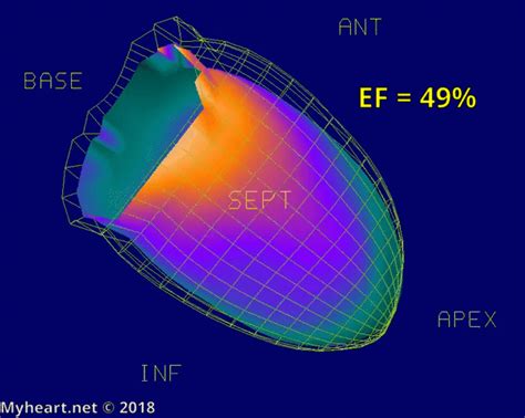 Heart Function Including Ejection Fraction (EF) • MyHeart