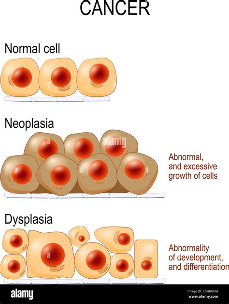 Células normales, displasia (anormalidad en el desarrollo y diferenciación) y neoplasia ...