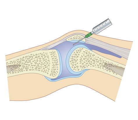 Synovial (or Joint) Fluid Analysis