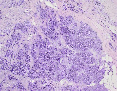 Acinic cell carcinoma (breast) – BosnianPathology