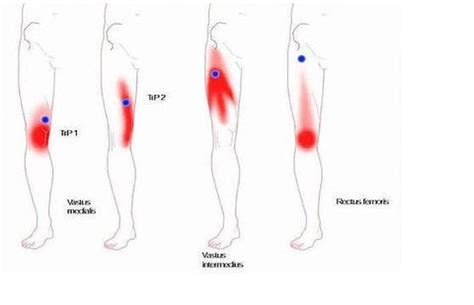 The Iliopsoas Muscle: Pain & Trigger Points | Pso-Rite™