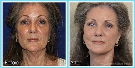 Laser facial treatment for wrinkle