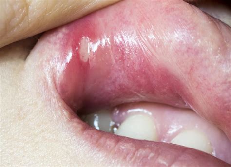 Mouth ulcers: Types, causes, symptoms, and treatment