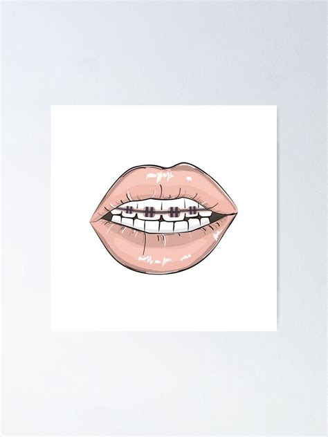 "Lips braces" Poster by Milatoo | Redbubble