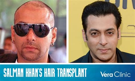 Salman Khan Hair Transplant Journey: From FUT to FUE