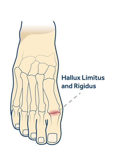 Big Toe Pain (Hallux Limitus) and Rigidus | Dapto Foot Clinic | Your ...