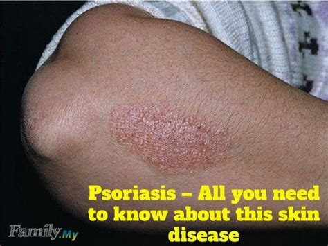 Psoriasis – All you need to know about this skin disease - Malaysia Health Family medicine and ...