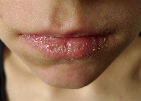 eczema around lip - pictures, photos