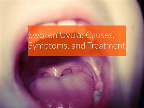 Swollen Uvula - Causes, Symptoms, and Treatment - The Healthy Apron