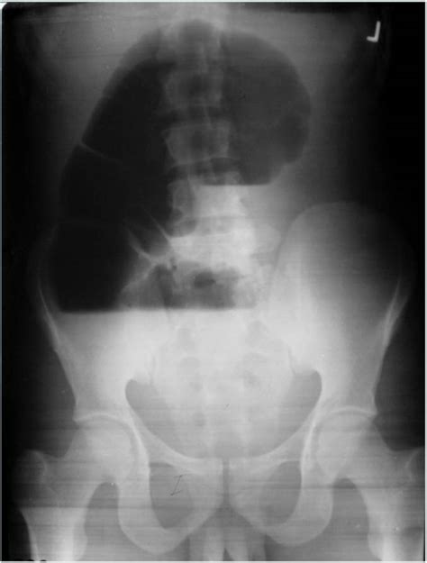 Cecal Volvulus - radRounds Radiology Network