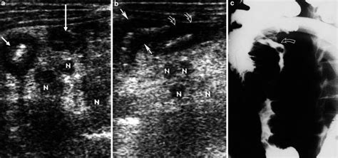 Intestinal Tuberculosis | Radiology Key