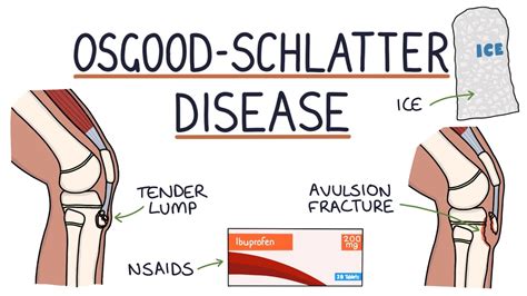 Understanding Osgood-Schlatter Disease - YouTube