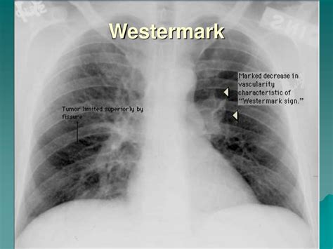 PPT - Pulmonary Embolism PowerPoint Presentation, free download - ID ...