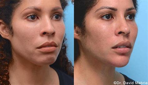 Nonsurgical Chin Augmentation, Neck Slimming & Jaw Contouring in San Francisco | Dr. David C. Mabrie