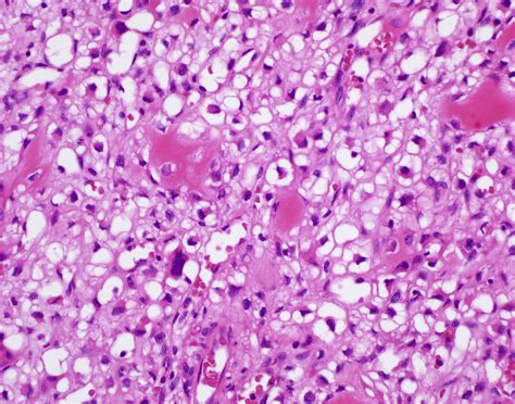 Histologic variants of chondrosarcoma - Diagnostic Histopathology