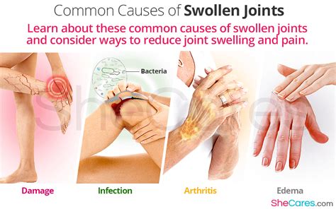 Joint Swelling: Causes and Solutions | SheCares