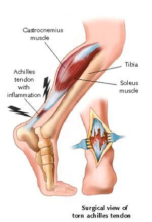 Tendonitis - symptoms, causes, diagnosis, Tendonitis treatment