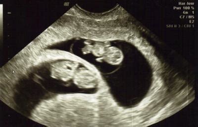 My Twins Ultrasound 9 Weeks