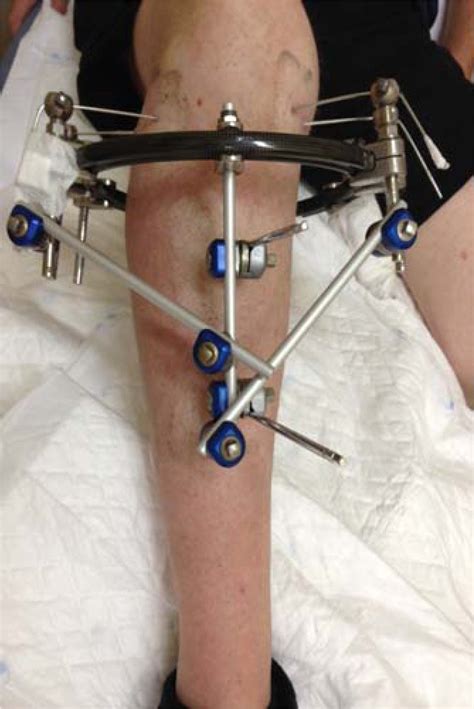 Severe tibial plateau fractures (Schatzker V–VI): open reduction and internal fixation versus ...