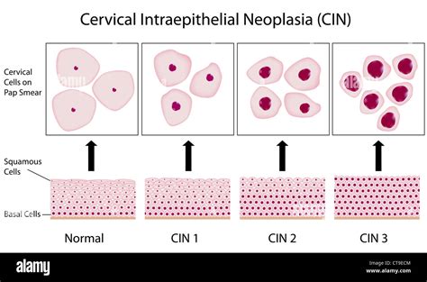 Pap Smear Test Results / For an ascus abnormal pap smear result: - sixsaltd