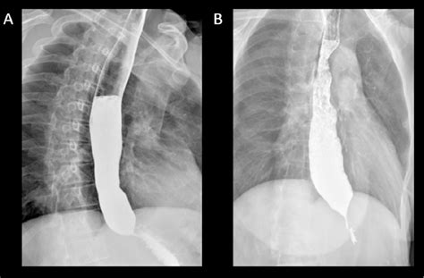 Figure 3 from Timed barium swallow in the assessment of esophageal emptying in patients with ...