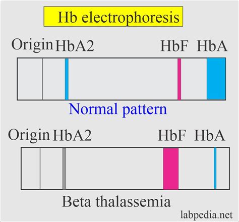 Anemia:- Part 4 - Thalassemia, α-thalassemia and β-thalassemia ...