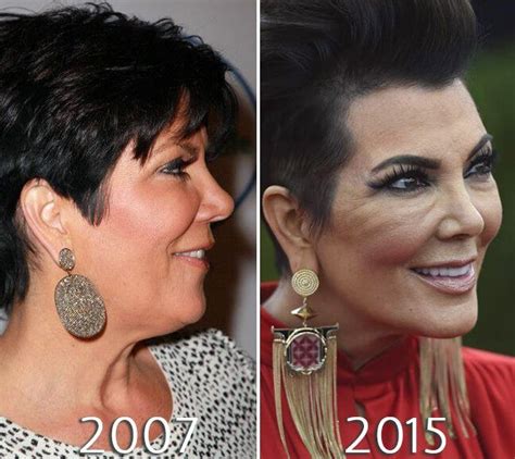 Kris Jenner facelift before and after photo | Kris jenner plastic ...