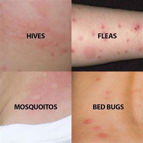 Identifying Bed Bug Bites: Symptoms, Signs, and Pictures