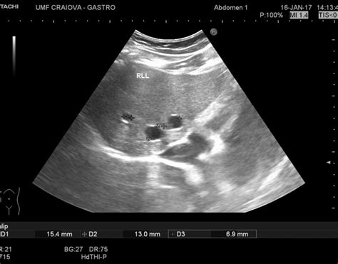 Liver Cyst – EFSUMB