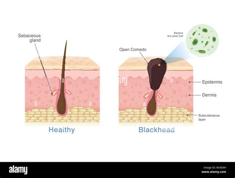 Bacteria in blackhead with human skin layer structure and Healthy skin Stock Vector Image & Art ...