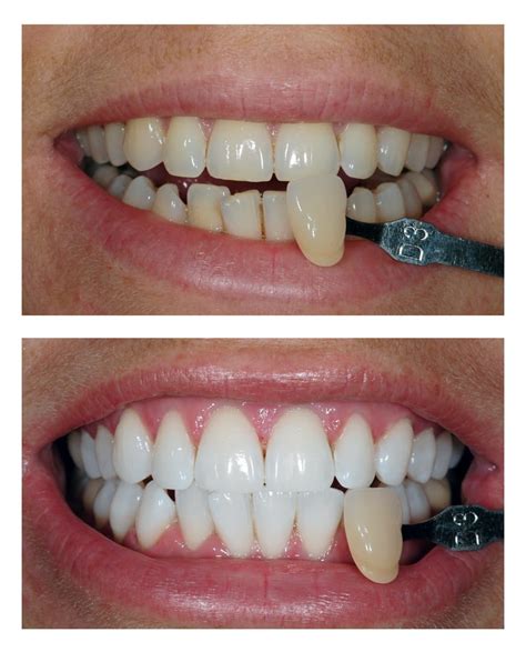 Teeth Whitening Bromley | All Smiles Dental | Tooth Whitening Bromley