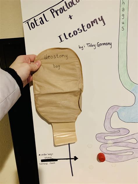 Total Proctocolectomy with Permanent Ileostomy – Human STEAM