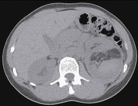 Solid renal lesions | Radiology Key