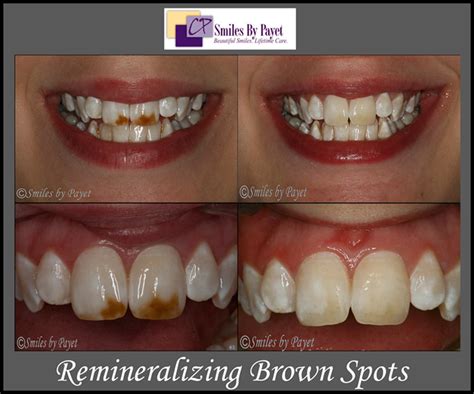 Teeth Whitening Before And After Stains