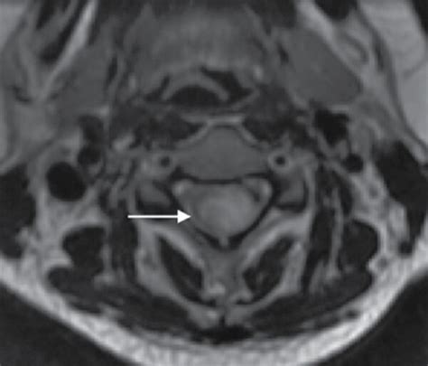 Cervical spinal cord MRI of an NMO patient in our center, a 32-year-old... | Download Scientific ...